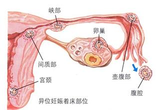 棕南专家介绍：女性不孕症的症状有哪些？